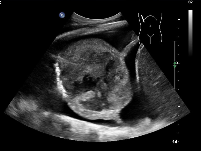 Endosonographische Darstellung einer pleuralen Metastase bei Magenkarzinom mit inhomogener echoarmer Raumforderung im Ultraschallbild, aufgenommen im Endosonographie-Atlas des Albertinen Krankenhauses Hamburg