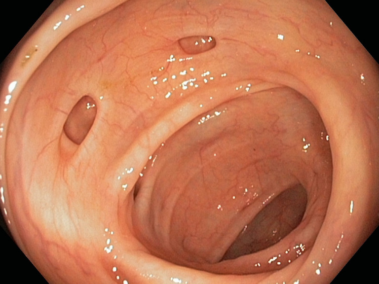 Koloskopisches Bild eines Smiley-Divertikels im Kolon mit zwei benachbarten Divertikelöffnungen, aufgenommen während einer hochauflösenden Endoskopie im Endoskopie-Atlas des Albertinen Krankenhauses Hamburg.